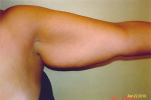 arm liposuction before