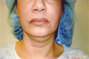 chin liposuction before