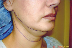 chin liposuction before