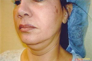 chin liposuction before