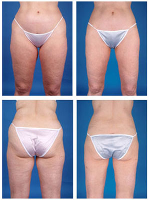 Liposuction Before & After's